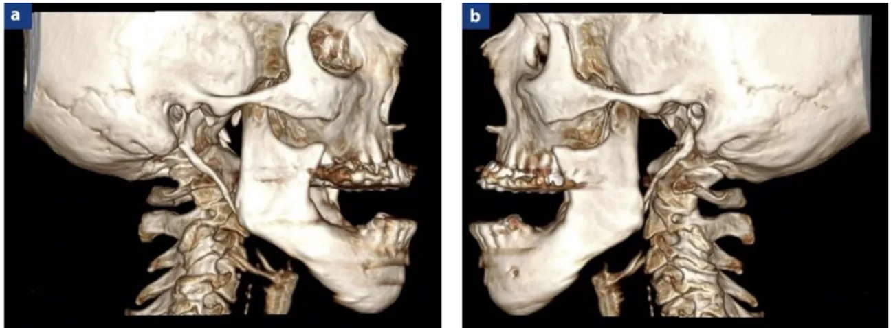 Figure 14 : Scanner cranio-facial avec reconstructions tridimensionnelles mettant en évidence la luxation  antérieure des condyles mandibulaires droit (a) et gauche 