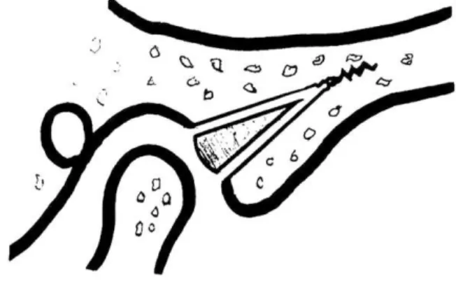 Figure 15 : Ostéotomie oblique avec placement d’un greffon osseux 