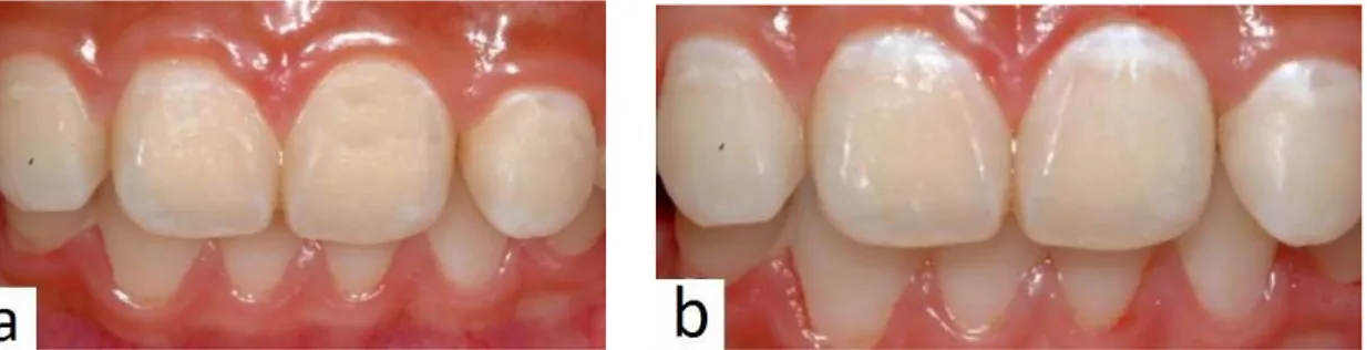Figure  n°  1 :  Surfaces  dentaires,  non  séchées  et  non  nettoyées  (a).  Taches  blanches  de  déminéralisation visibles après séchage et nettoyage des surfaces dentaires (b)