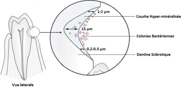 Figure 4: Vue latérale d'une LCU et de la couche hyper-minéralisée. Figure modifiée d’après Badel T  et  col.(5) 