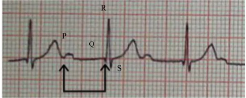 Figure  B  :  Electrocardiogramme  montrant  un  Bloc  auriculo-ventriculaire  de  premier  degré  chez  un  patient  RAA 
