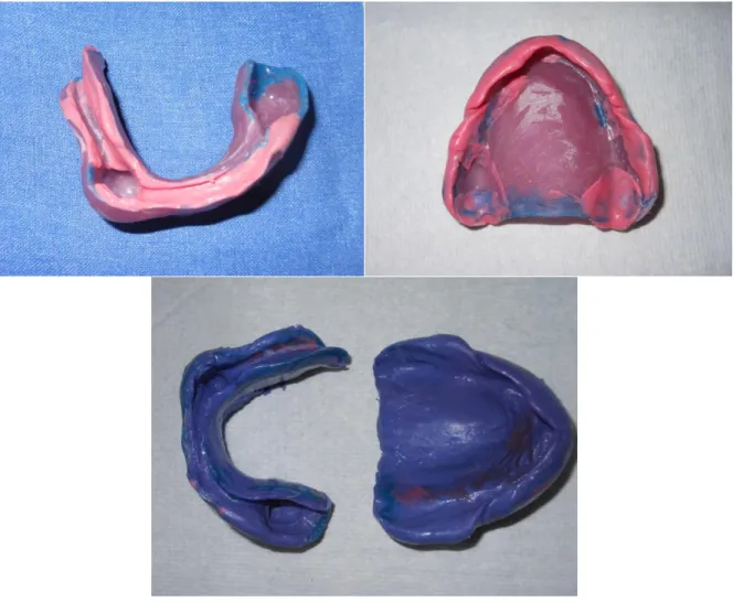 Fig. 5 : Empreintes secondaires maxillaire et mandibulaire 