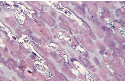 Figure 4 : Apparence histologique d’un os ostéopétrotique.  