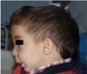 Figure 5 : Vue latérale de la tête d’un enfant montrant le visage pâle et large avec une  macrocéphalie