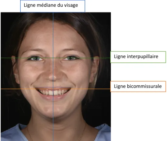Figure 1 : Représentation des lignes de référence esthétiques de la face. (crédit  photographie : B.Cazaux) 