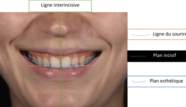 Figure 3 : Représentation des critères esthétiques lors d’un sourire naturel. (crédit  photographie : B.Cazaux) 