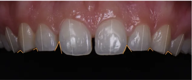 Figure 4 : Représentation de l’agencement axial et des embrasures occlusales. (crédit  photographie : B.Cazaux) 