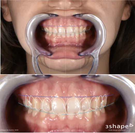 Figure 9 : Modélisation du projet esthétique virtuel avec le logiciel Trios smile design