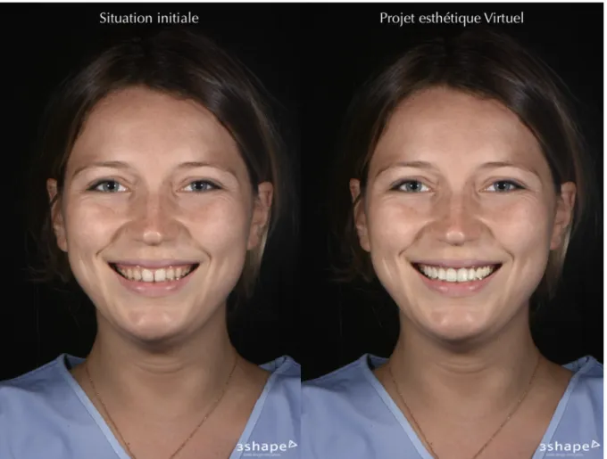 Figure 10 : Réalisation d’un mock-up virtuel à partir de l’application Trios smile design