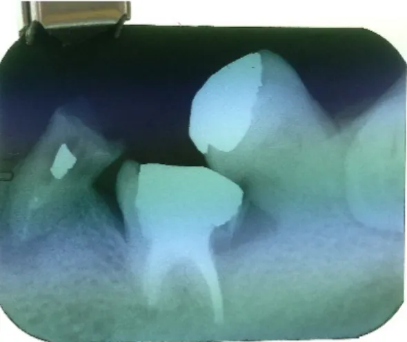 Figure 3 :  cliché  rétroalvéolaire d’une  36 ankylosée et en réinclusion (crédit photo de Erwan RUTTIMANN).