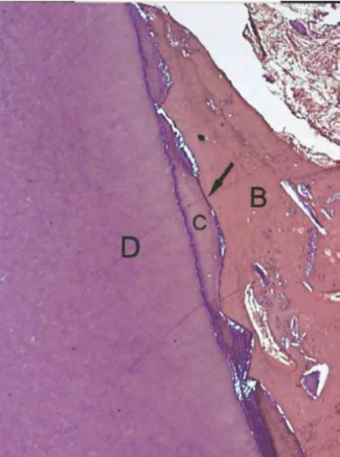 Figure 7 : coupe histologique d’une ankylose alvéolo-dentaire. B : os alvéolaire C : cément D : dentine (27).