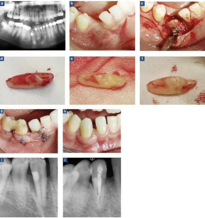 Figure 8 : étapes d’une extraction réimplantation de 43. a : radiographie panoramique pré- pré-opératoire attestant l’échec de traction orthodontique b : situation clinique pré-pré-opératoire c : incision et décollement d : extraction exposant la zone anky