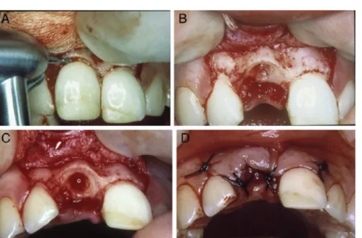 Figure 10 : étapes de la décoronation. A : section coronaire B : réduction coronaire et désobturation endodontique C : formation du caillot D : suture du lambeau (42).