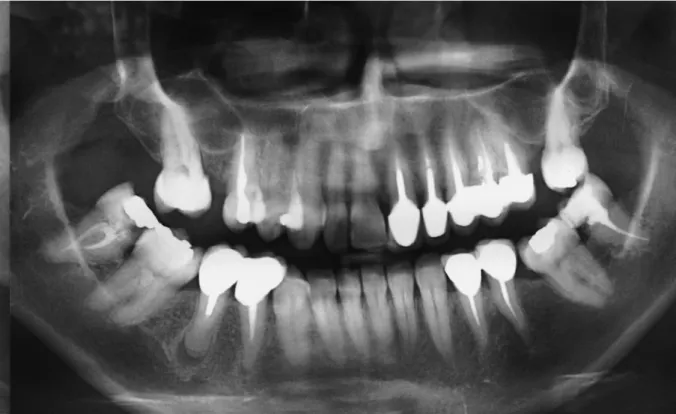 Figure 6. Radiographie panoramique d’une femme de 52 ans. 