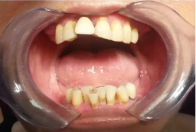 Figure 2 : Patiente atteinte de parodontite chronique généralisée   (crédit photo A. JABOL) 