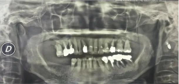 Figure 3 Evaluation radiologique de l'atteinte osseuse: parodontite chronique sévère  généralisée (crédit photo A