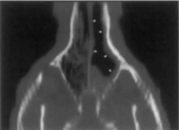 FIG. 3.  Dorsal  image,  reformatted,  of  a  5-year-old  rottweiler.  There  is  destruction  of  the  turbinates  and  mucosal  thickening  (arrowheads)  in  the  left  nasal cavity