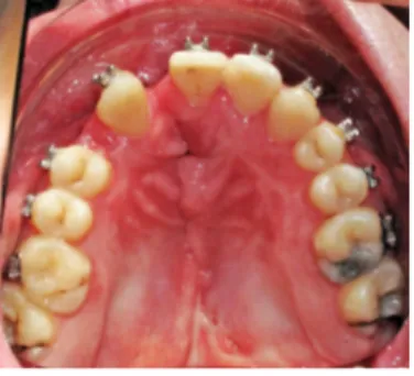 Figure 13: Vue de l’arcade maxillaire d’un patient présentant une zone palatine plus étroite du côté de la  fente opérée