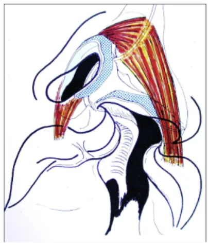 Figure 16: Représentation schématique dans une fente unilatérale complète du muscle nasal s’insérant  sur le petit fragment maxillaire (28)