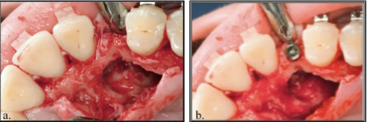 Fig. 5.   Délabrements osseux lors d’une réhabilitation par extraction-implantation immédiate (21)  a