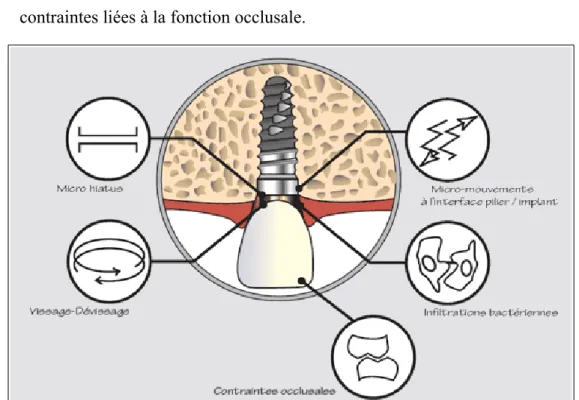 Illustration 3: Facteurs évoqués comme responsables d'une inflammation chronique à la jonction implant-pilier.(4) (25)