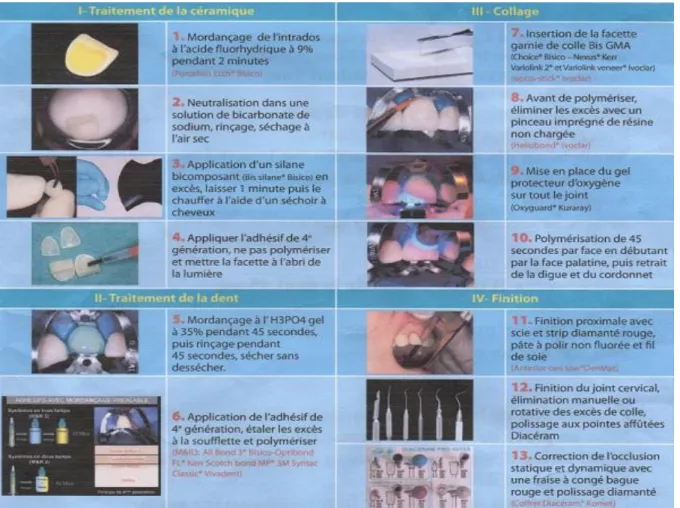 Fig 9 : Photographies issues de la fiche « step by step » esthétique par le Dr JF Lasserre groupe  symbiose