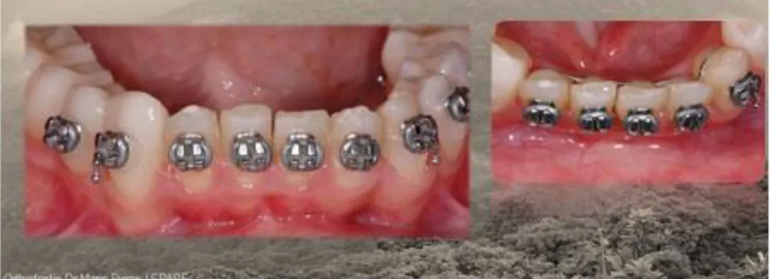 Fig 24 : Photographies réalisées par le Dr JF LASSERRE lors de la dépose du traitement orthodontique 
