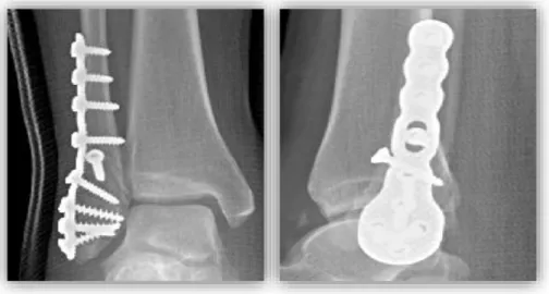 Figure N° 2 : Radiographies de face et de profil de cheville droite avec  ostéosynthèse par PNV (Vives™ – Stryker ® ) 