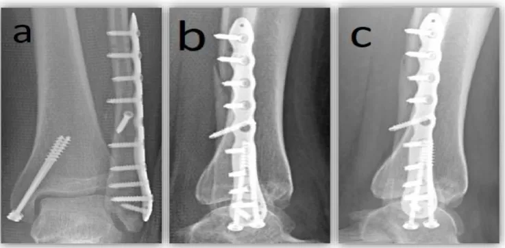 Figure N° 4 : Radiographies d’ostéosynthèse d’une cheville gauche par PV  (VariAx™ – Stryker ® ) - a) incidence de face à 6 semaines, b) incidence de profil à 