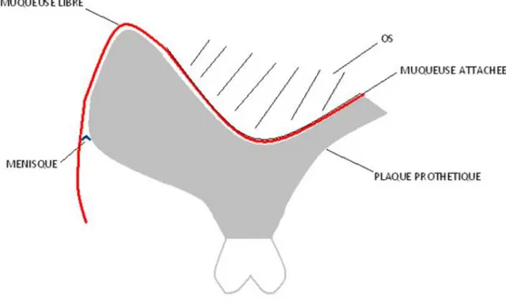 Figure 3 :   Schéma de la rétention prothétique 