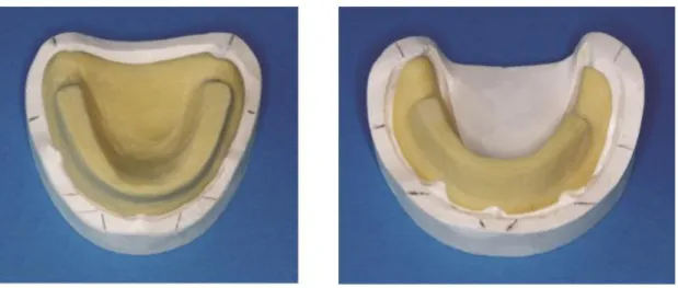 Figure 16 - Portes-empreintes individuels maxillaire et mandibulaire avec bourrelet de préhension 