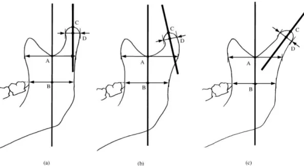 Figure 2 : Inclinaison condylienne selon Hwang. Le condyle et la branche montant du ramus ont  été tracés des deux côtés de la radiographie