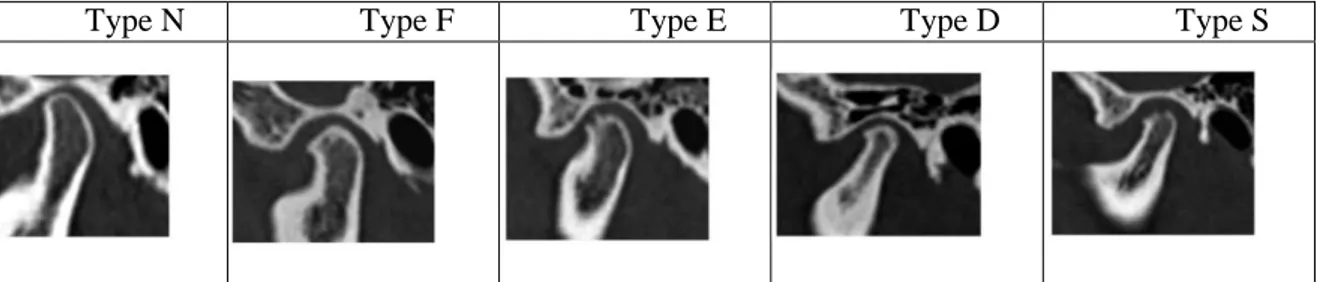 Figure 6 : Classification scanographique des anomalies osseuses dans les pathologies dégénératives de l’ATM