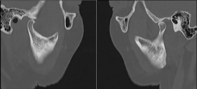 Figure 6 : Scanner des ATM droite et gauche en position bouche ouverte patiente 1. 