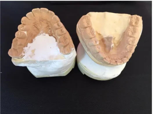 Figure 1 : Modèles en plâtre maxillaire et mandibulaire 