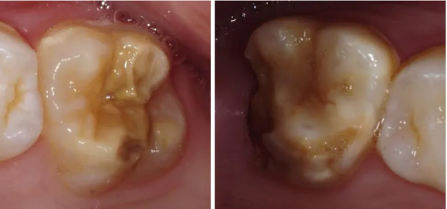 Figure 3 : Situation clinique de défauts MIH situés sur des premières molaires permanentes avec les dents atteintes n°16 et  26 de gauche à droite (courtoisie Dr Elsa Garot)