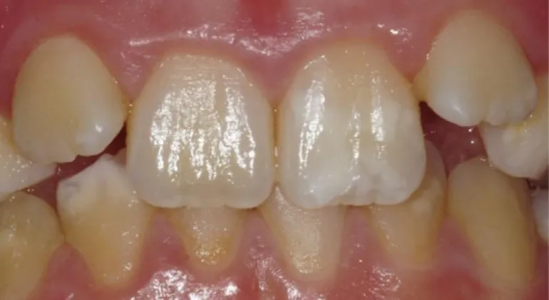 Figure 4 : Situation clinique de défauts MIH sur des incisives permanentes avec les dents atteintes n°21 au maxillaire et n°42  et 32 à la mandibule de gauche à droite (courtoisie Dr Elsa Garot)