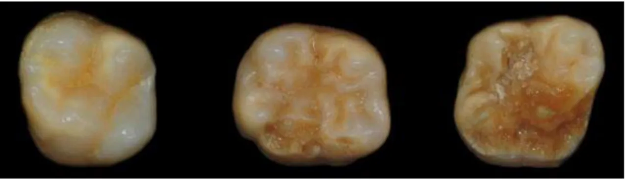 Figure 5 : Sévérité des défauts (de gauche à droite : léger, modéré et sévère) issus de dents actuelles avec de gauche à droite  les dents n° 26, 46 et 16 (Melbourne dental school, Australie) (courtoisie Dr Elsa Garot)