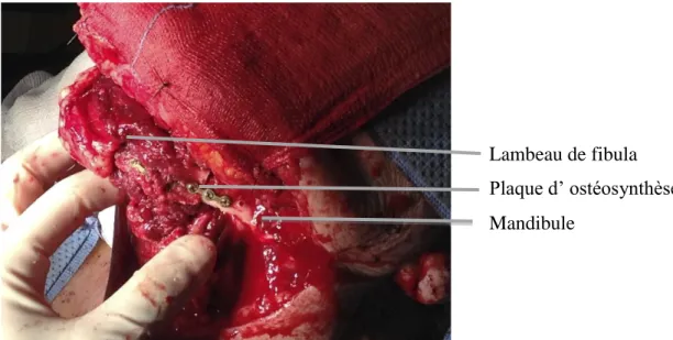 Figure 7 : Ostéosynthèse du lambeau de péroné à la branche mandibulaire gauche  Lambeau de fibula  Plaque d’ ostéosynthèse Mandibule 