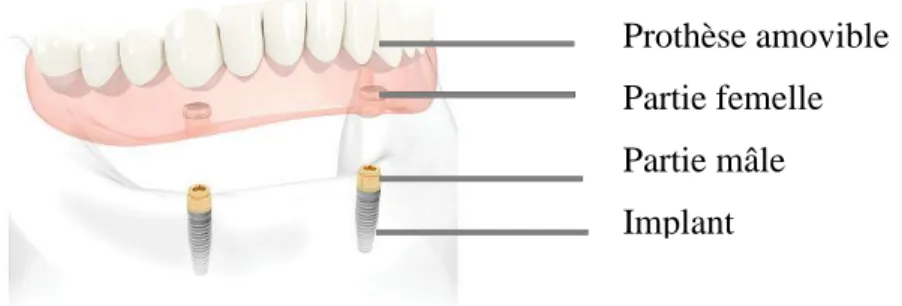 Figure  13  Attachement  Locator  :  Système  de  bouton/  pression.  Parties  « mâle »  dorées  se  vissant sur l'implant, parties « femelle » collées dans l'intrados de la prothèse