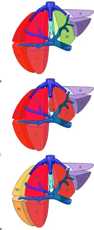 Figure 6 : représentation schématique des hépatectomies majeures les plus réalisées 