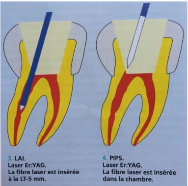 Figure 10 : Insertion de la fibre laser selon la technique utilisée (70) 