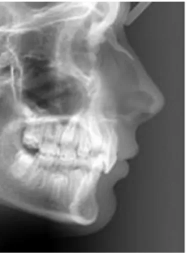 Figure 8. Le profil cutané sur une téléradiographie de profil et la position haute du  stomion par rapport à l'incisive mandibulaire (Marie-José Boileau) 