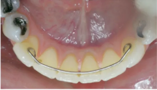 Figure 5: fil en acier inoxydable .025 inch collé sur les canines mandibulaires avec boucles de rétention 