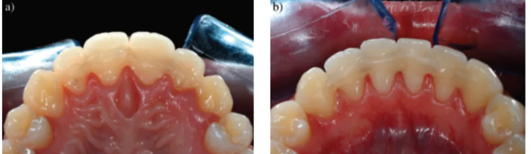 Figure 10: Contentions en composite renforcé aux fibres de verre (CRF), a) maxillaire; b) mandibulaire 