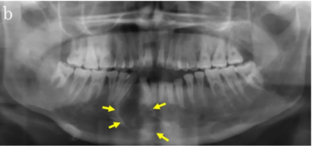 Figure 2 : Radiographie panoramique montrant une radioclarté