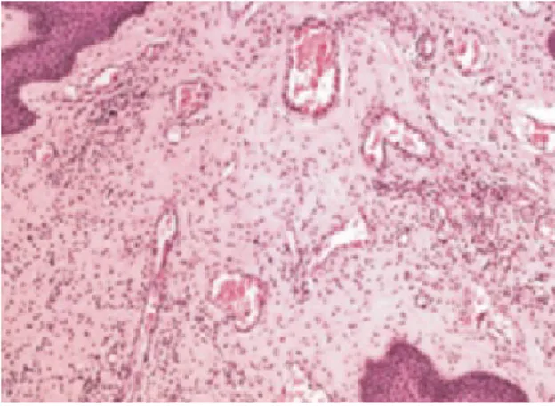 Figure 5 : Coupe histologique d'un fibrome oral après coloration à l'hématoxilline et éosine