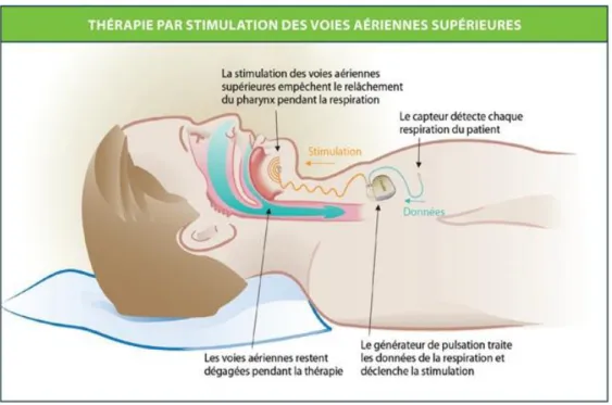 Fig. 4 : Effets de la thérapie INSPIRE® II observé  sous endoscopie sous sommeil induit sous anesthésie  générale (document Inspire Medical System)