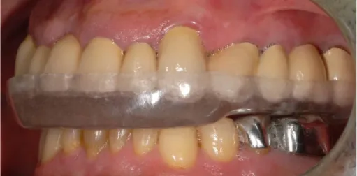 Figure 10 – Gouttière occlusale de protection et de stabilisation. (Photographie E. d’Incau) 