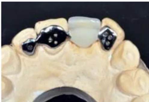 Figure 12 : Bridge de Rochette dans le remplacement d’une incisive centrale maxillaire